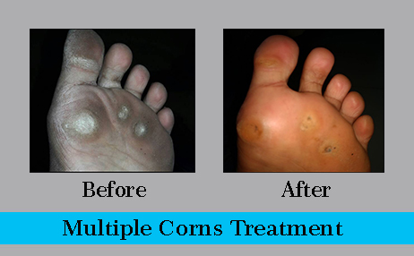 multiple corns treatment