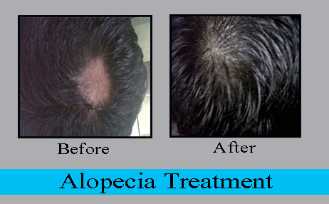 alopecia