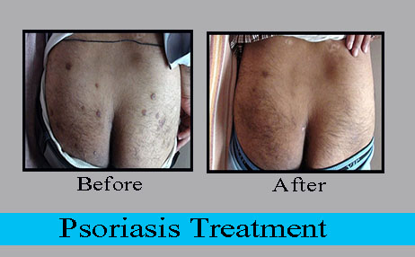 psoriasis