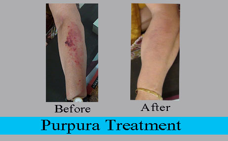 Purpura