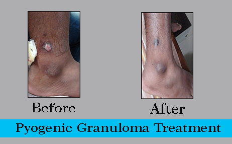 pyrogenic granuloma 