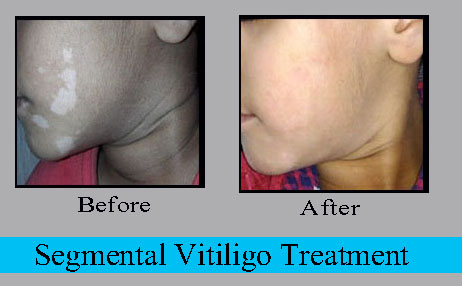 segmental vitiligo